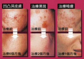 特效暗瘡去印治療