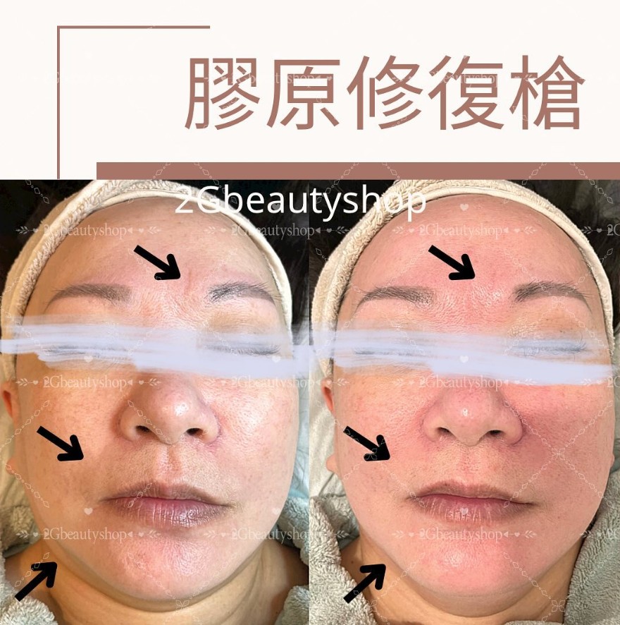 膠原修復槍