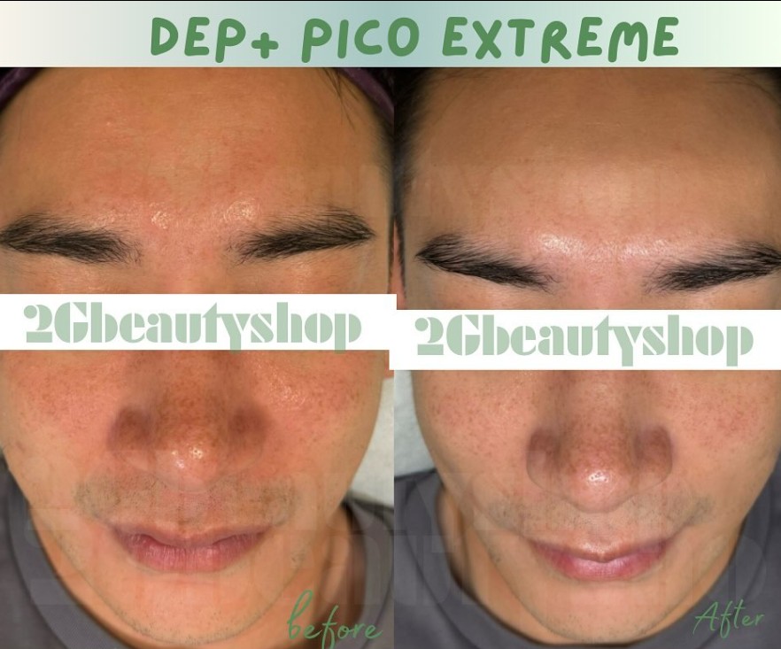 皮秒激光療程後會出現反黑情況