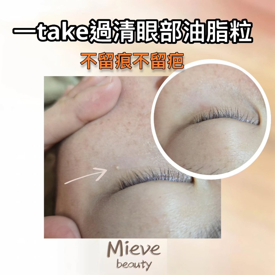 消除油脂粒一Take過