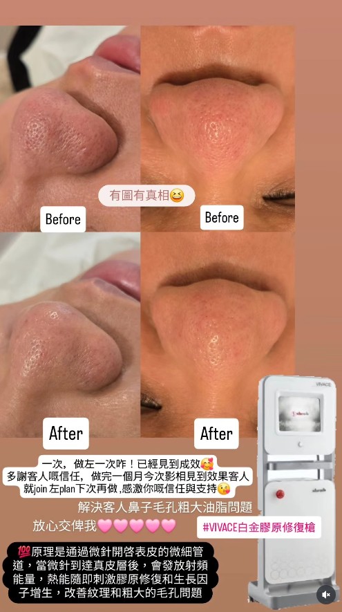 Vivace鉑金膠原槍將三種技術（微針+射频+LED)