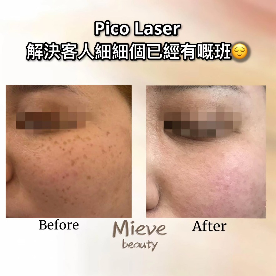 客人7歲已經有雀斑， 細細個喜歡運動成日曬