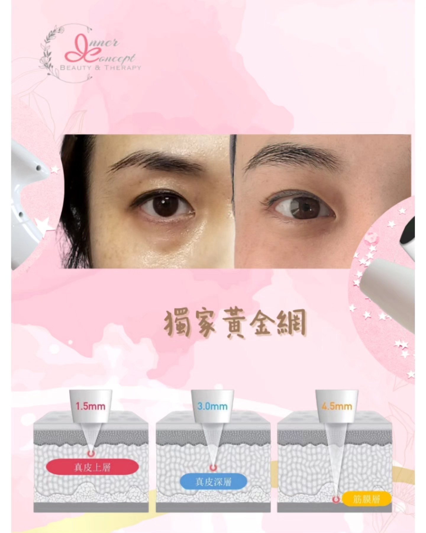 處理眼袋問題並不困難