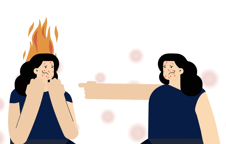 您的痘痘問題嚴重嗎？