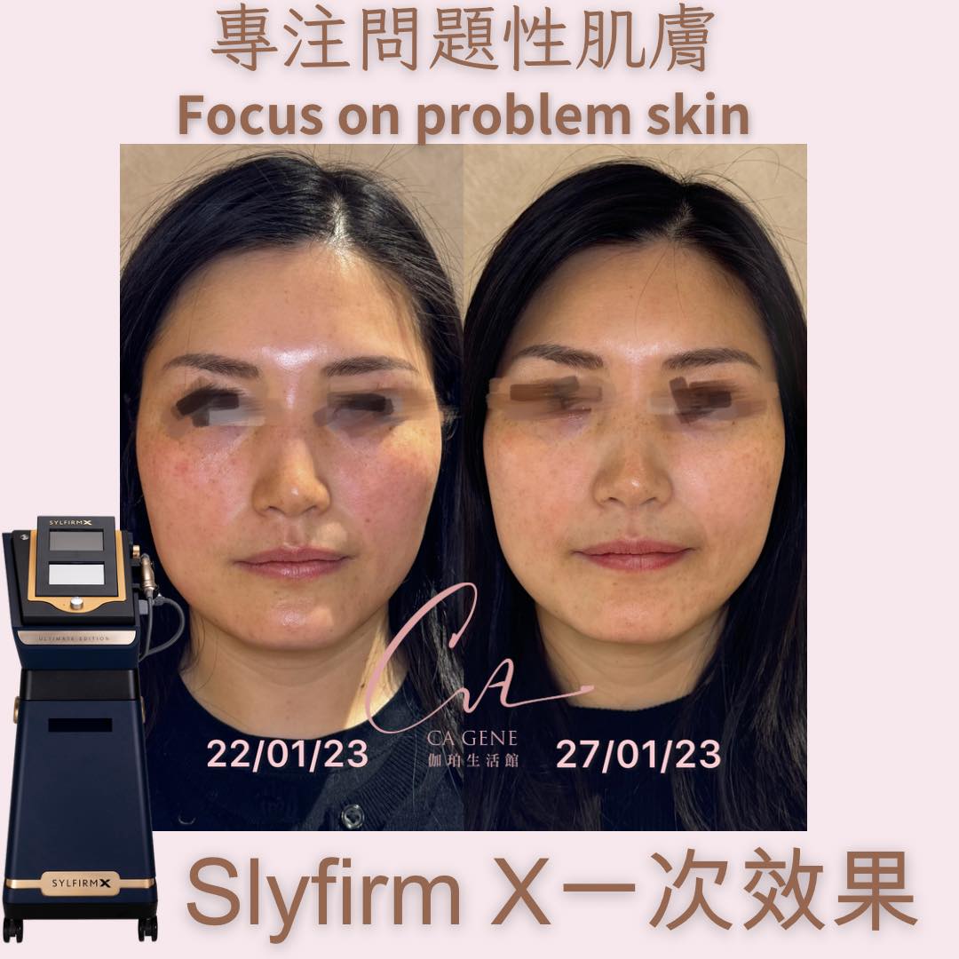 養膚計畫再升級！SylfirmX矽谷電波X