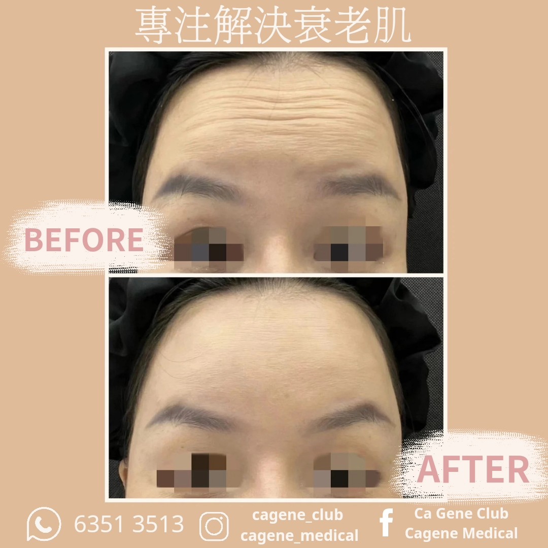 XEOMIN®️「零雜質的純淨肉毒桿菌素」