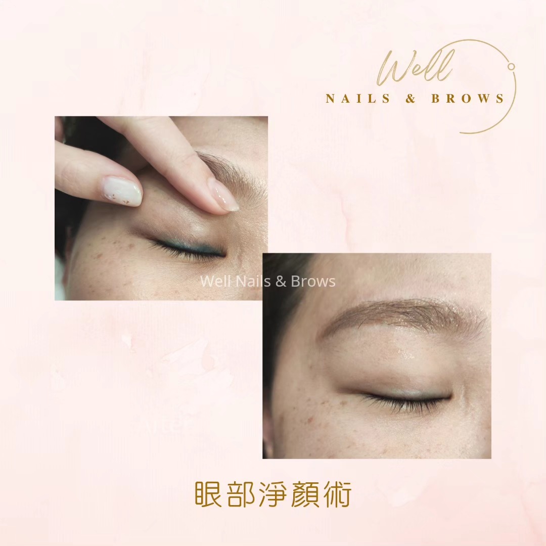眼部淨顏術