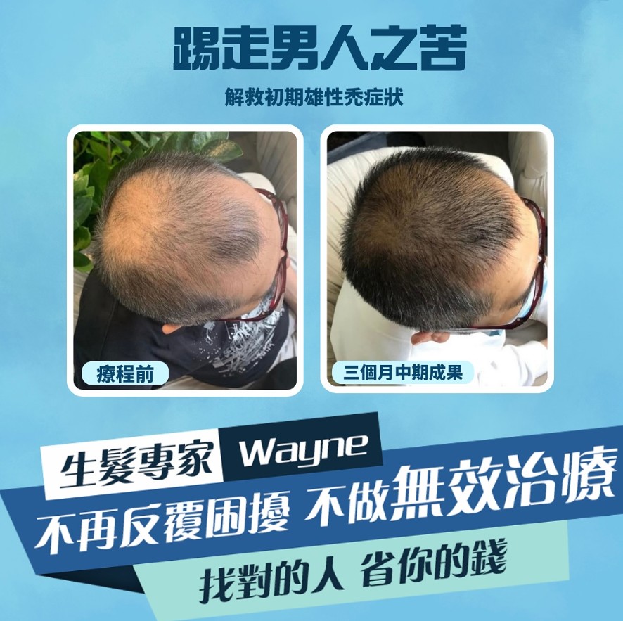 家族先天脫髮遺傳