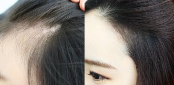 修補髮際線 