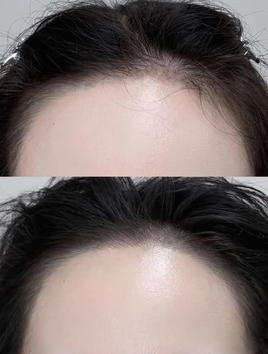 發際線後移 困擾了很多人