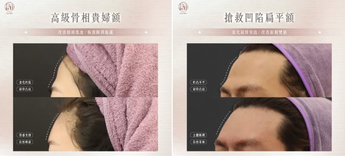 拯救凹陷扁平額