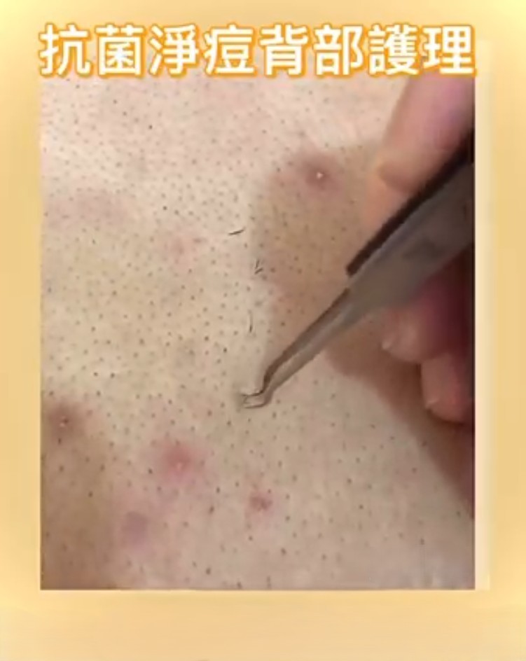 背部深層清潔護理