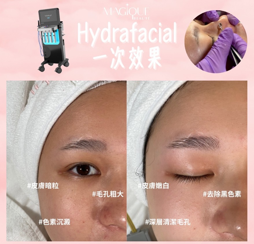 做好深層清潔 已經可以令皮膚白一度