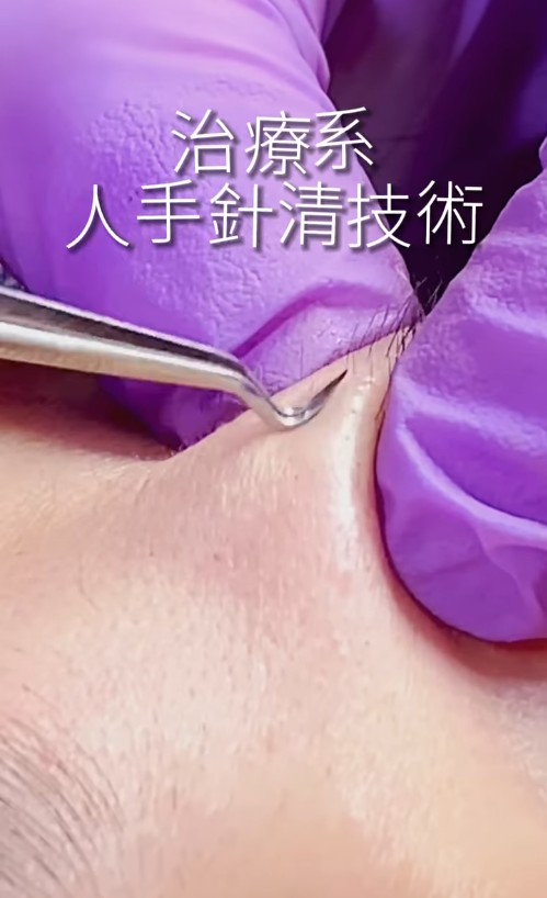 30年獨家針清手法, 徹底清潔深層皮膚