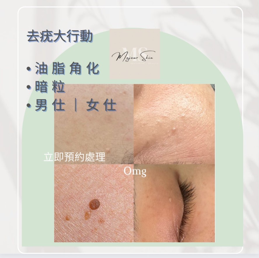 脫疣｜脱墨｜油脂粒 治療
