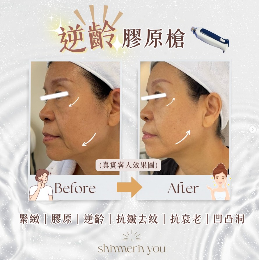 逆齡膠原槍運作模式